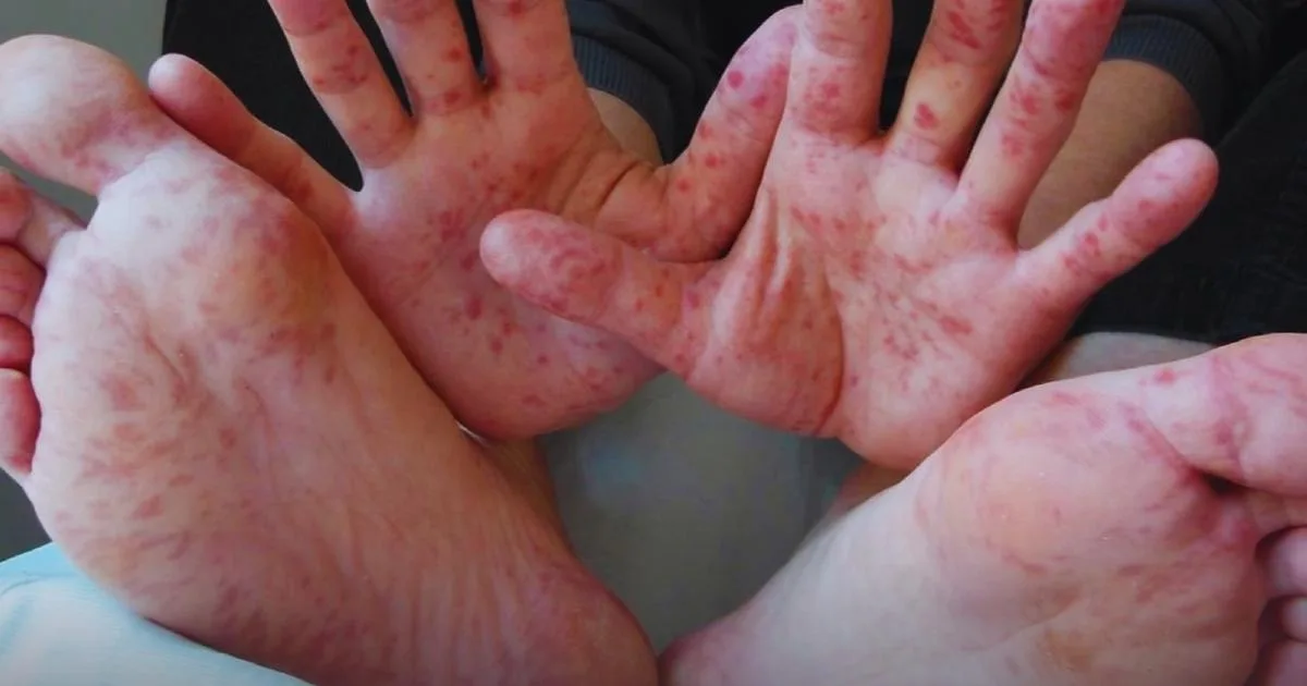 Aumentan alertas por virus Coxsackie en niños; llaman a reforzar prevención